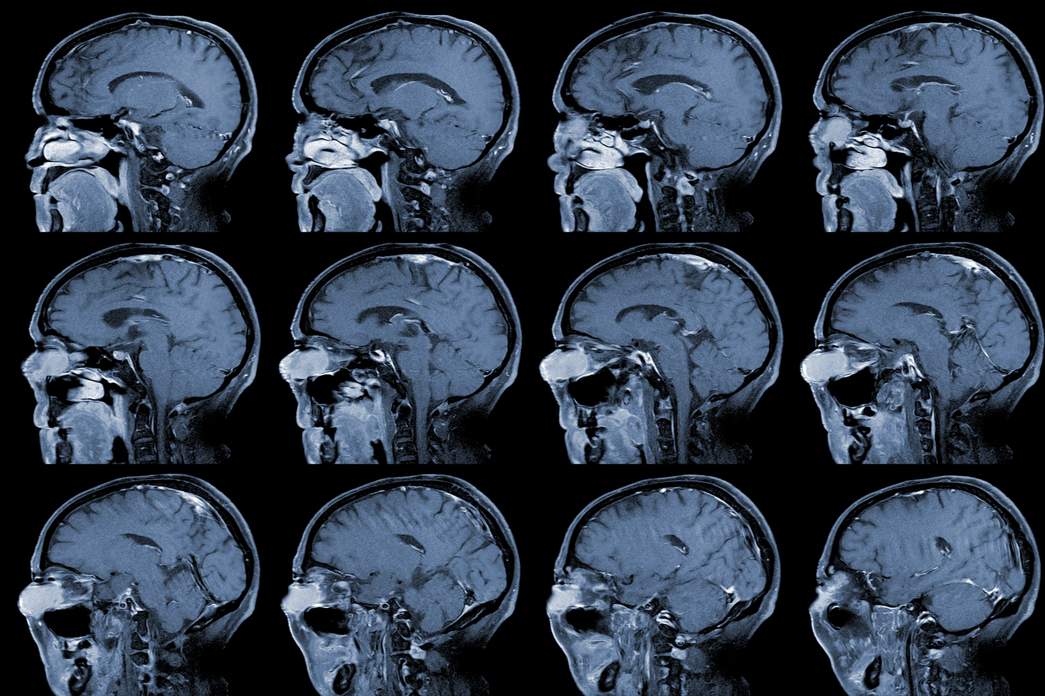 Aneurisma cerebral: principales riesgos y opciones de tratamiento