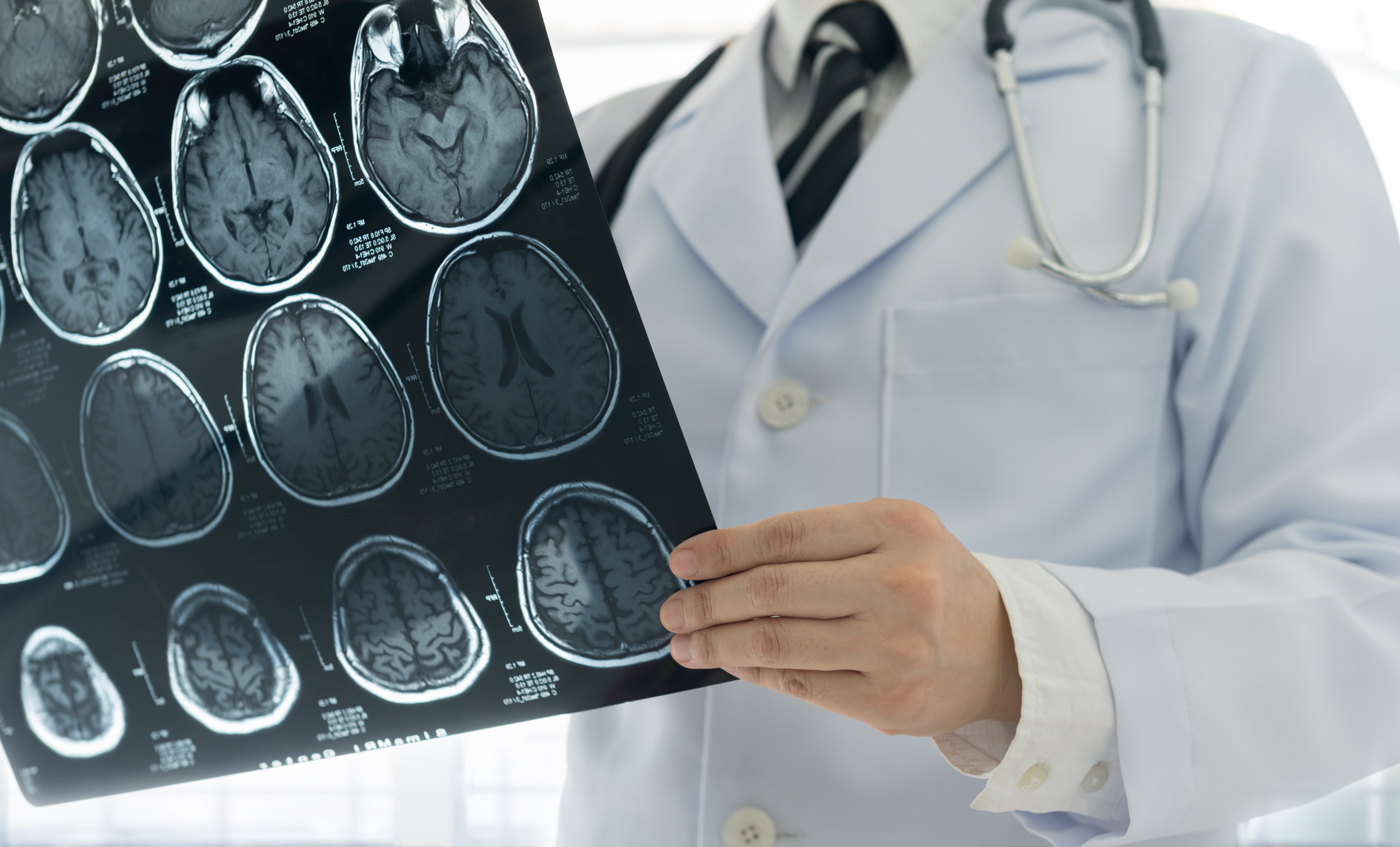 derrame cerebral