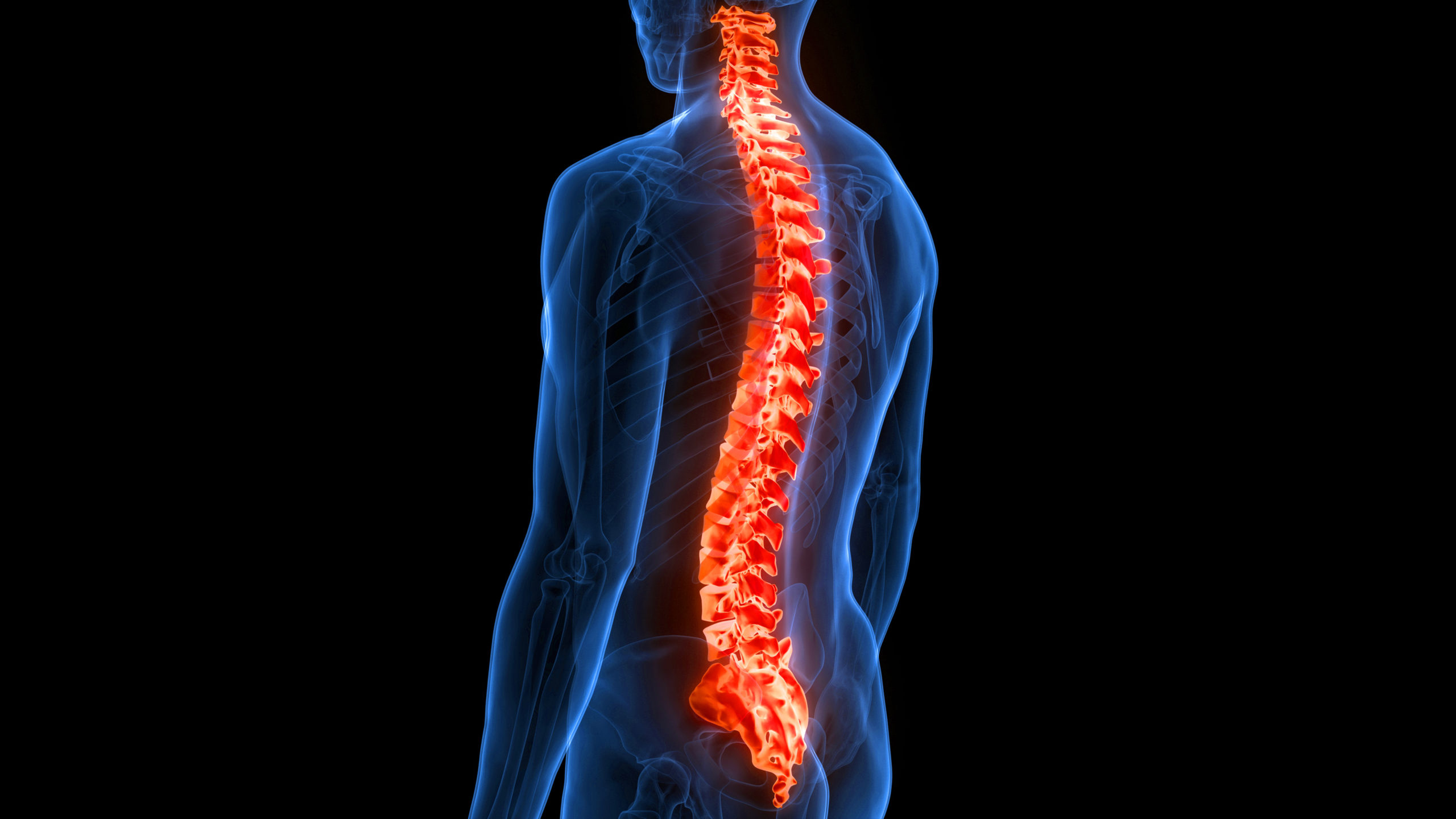 ¿Qué es un infarto medular y cuáles son sus opciones de rehabilitación?